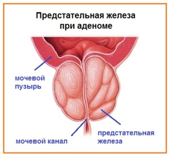 Аденома предстательной железы симптомы