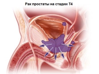 лечение рака предстательной железы 4 стадии